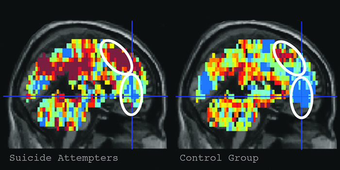 Потенциальных самоубийц можно распознать по МРТ