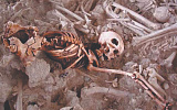 Трепанация черепа была очень распространенной операцией уже в доисторические времена